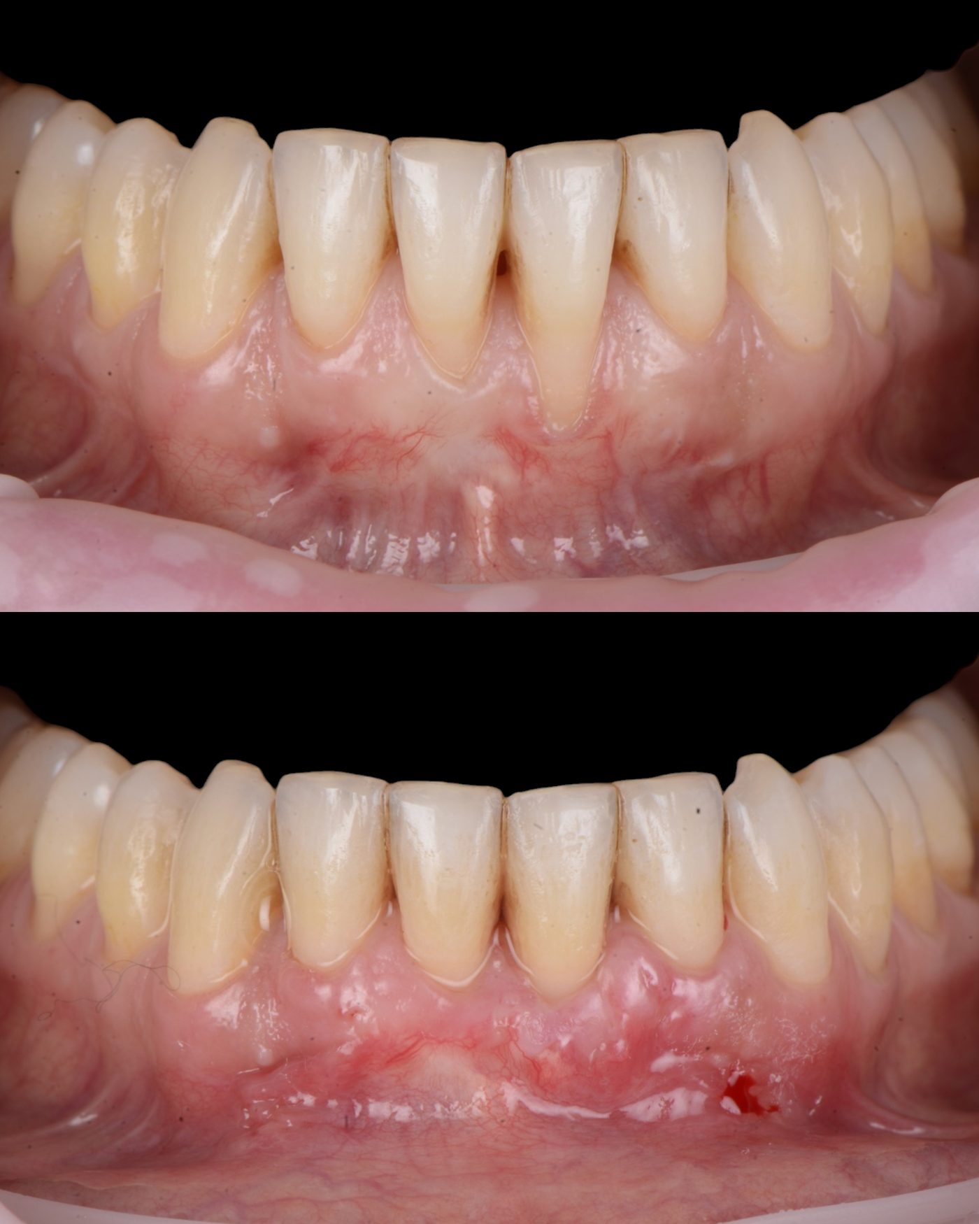 Chirurgie parodontală pentru acoperirea retracțiilor — before & after