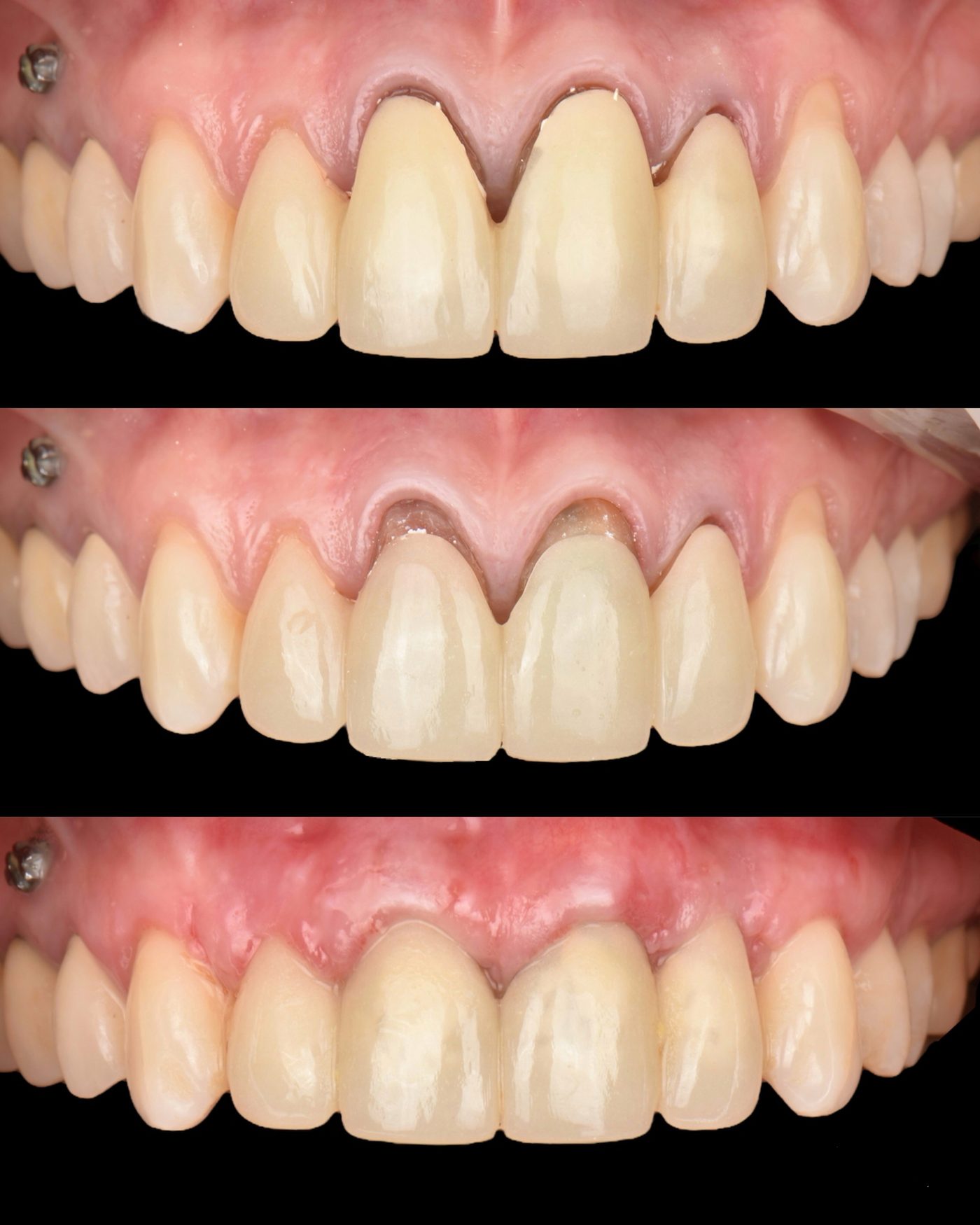 Acoperirea retracțiilor gingivale — before & after