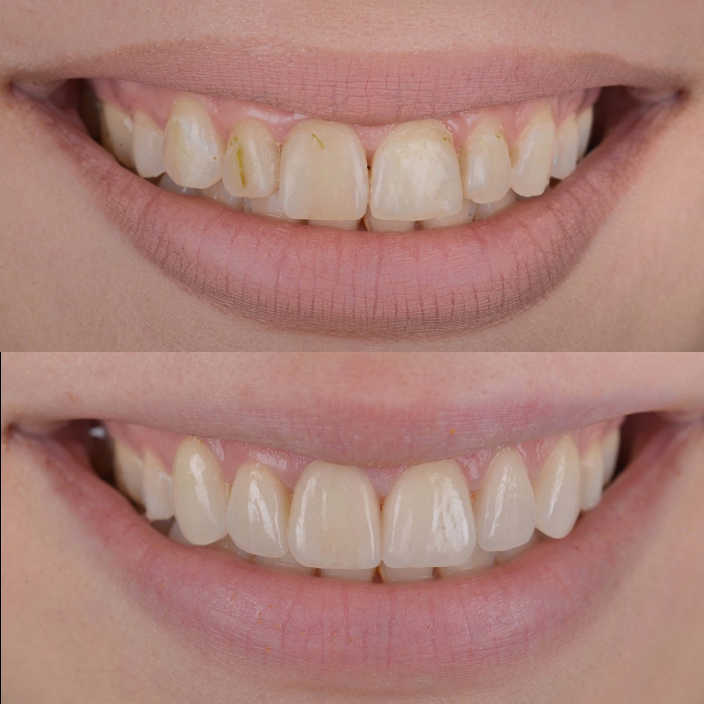 Fațete ceramice — before & after