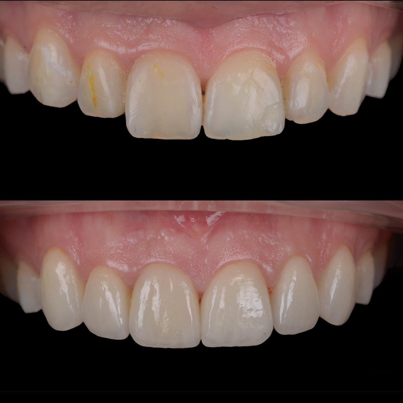 Fațete ceramice feldspatice — before & after