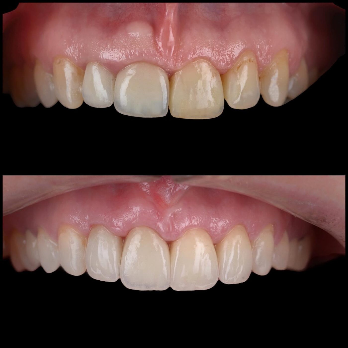 Gingivectomie și coroane ceramice — before & after