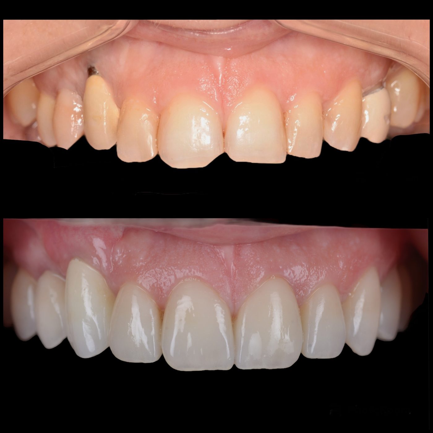 Acoperirea retracției pe implant și reabilitare estetică — before & after