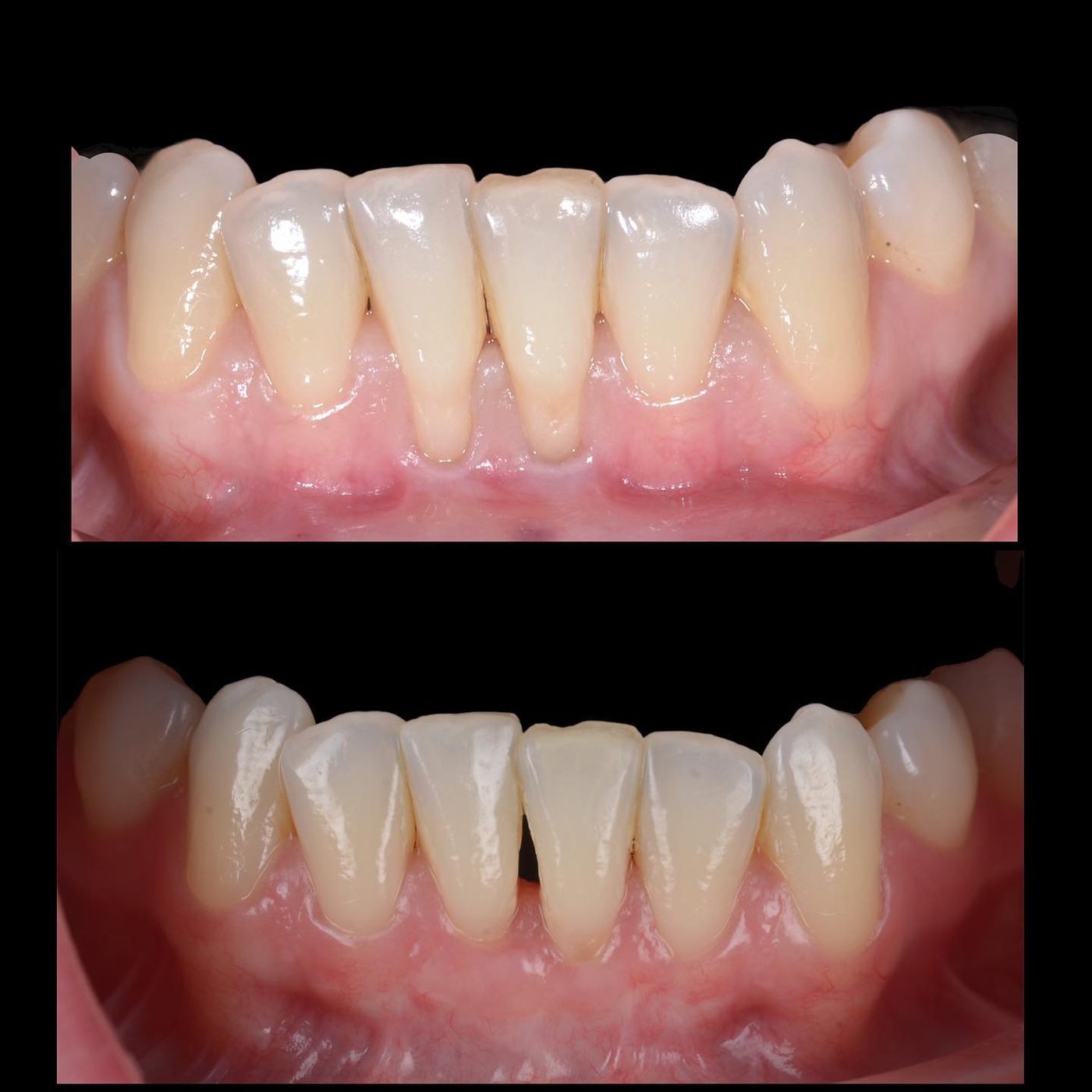 Microchirurgie parodontală pentru acoperirea retracțiilor — before & after