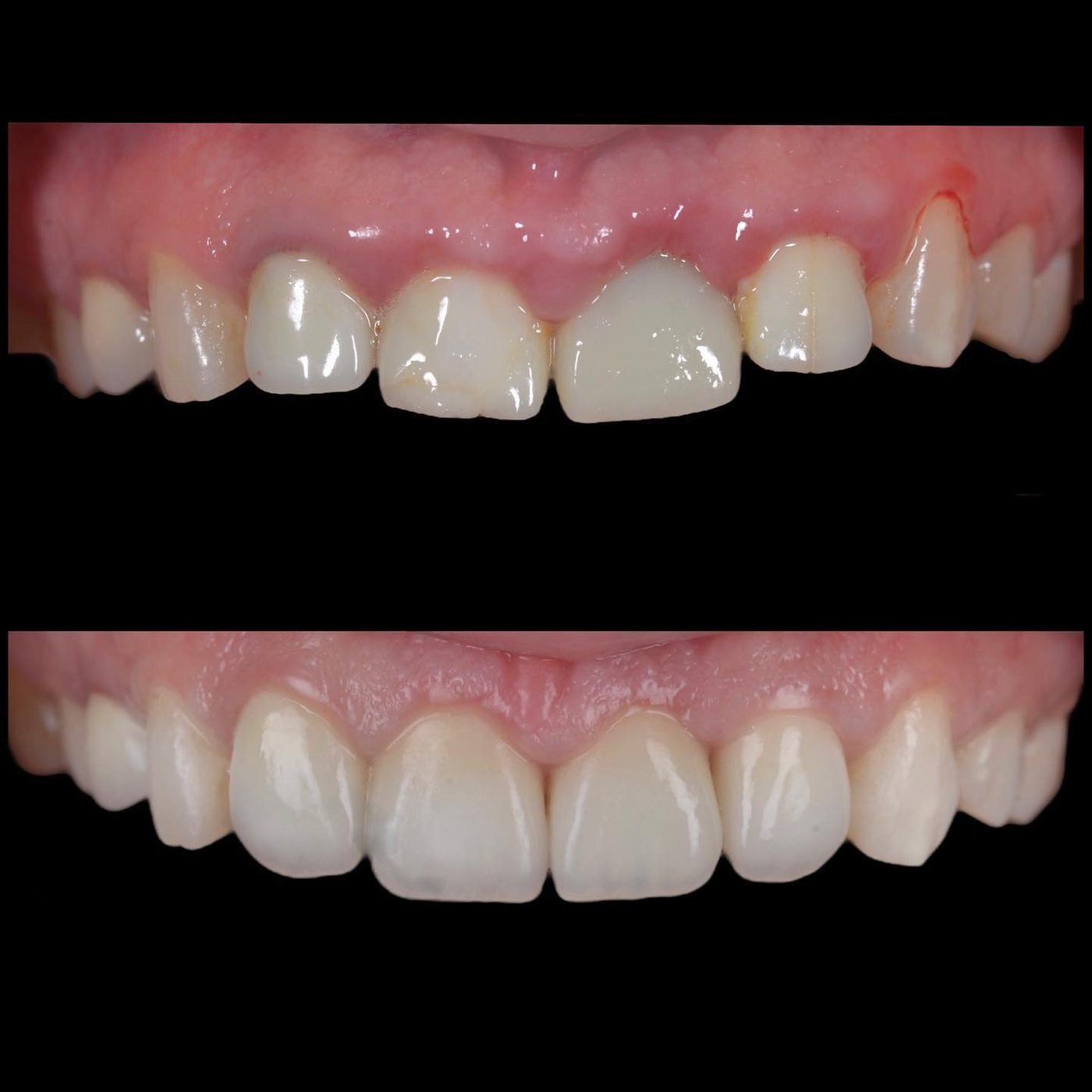 Tratament parodontal și coroane ceramice — before & after
