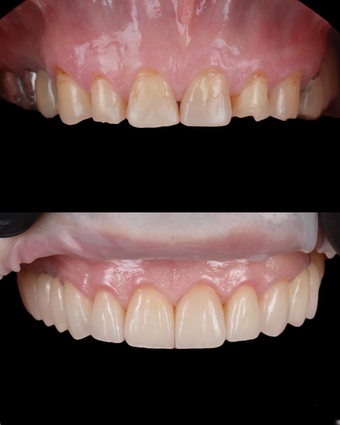Reabilitare completă cu fațete ceramice — before & after