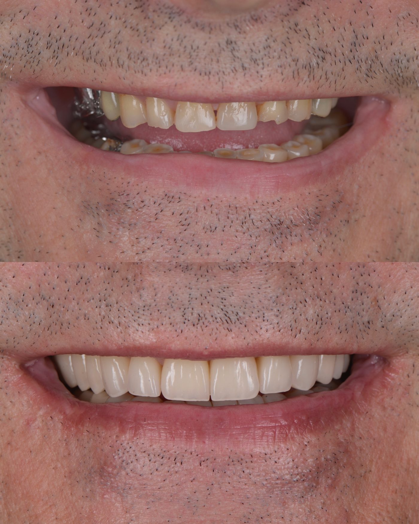 Reabilitare estetică cu fațete ceramice — before & after