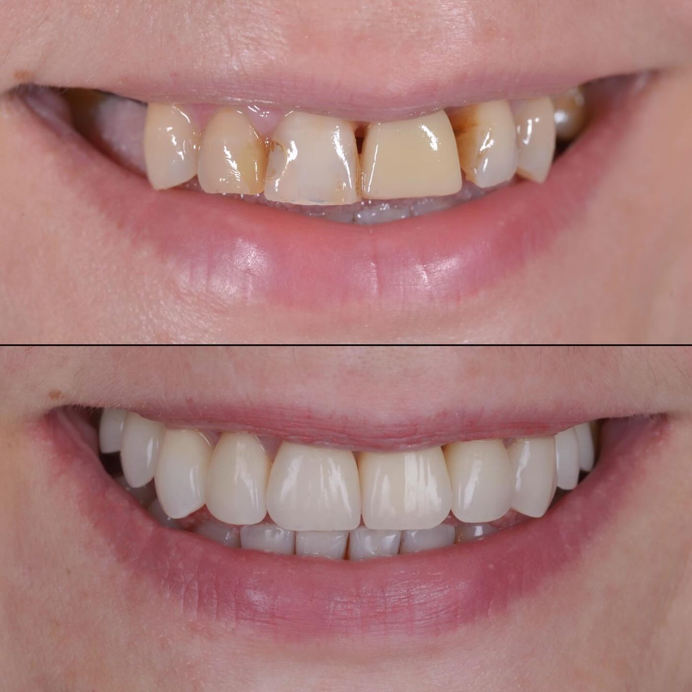 Reabilitare complexă implanto-protetică — before & after