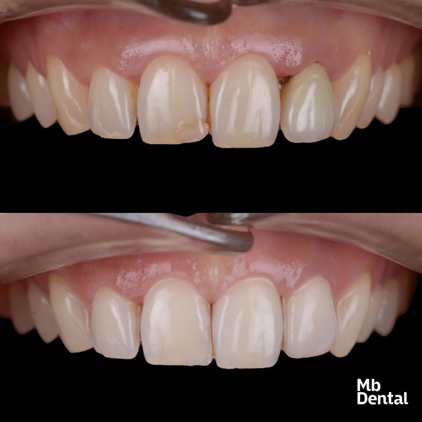 Reabilitare estetică minim invazivă — before & after